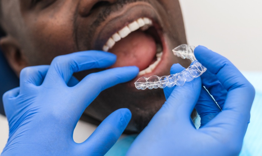 clear-aligners