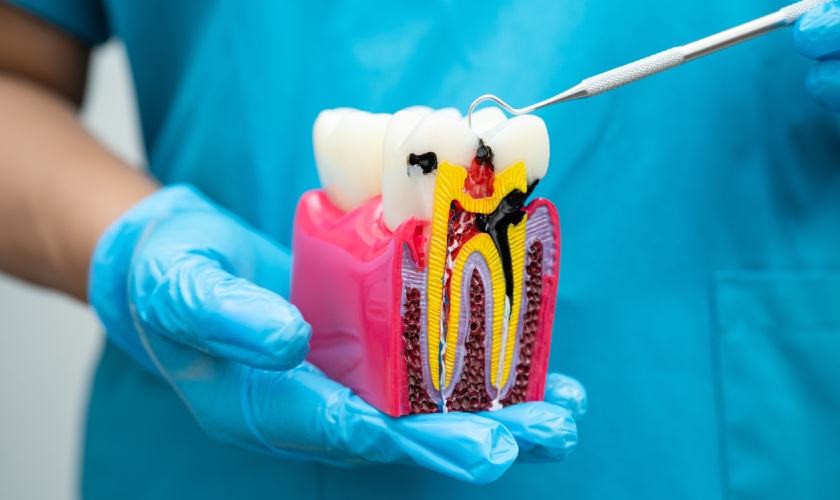 root-canal-treatment